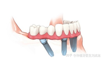 郑州无牙颌,可以做全口/半口种植牙吗?找副主任医师或主任医师做,是不是更有保障?