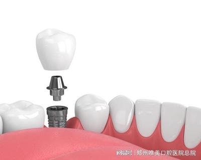 郑州种植牙|种植牙植入人体后,会出现排异反应吗?