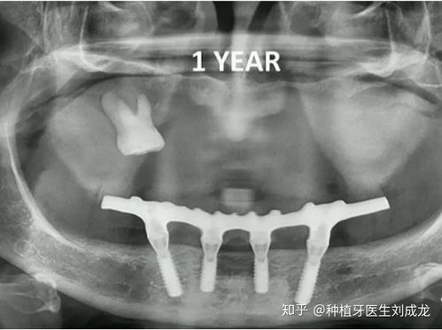 在郑州种瑞士iti瑞锆种植牙好吗 可有副主任医师或主任医师推荐