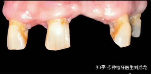 在郑州种瑞士iti瑞锆种植牙好吗 可有副主任医师或主任医师推荐