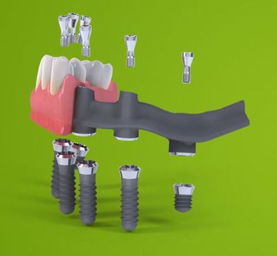 郑州瑞士ITI种植牙 导板辅助无牙颌全口修复，重塑舒适咀嚼功能