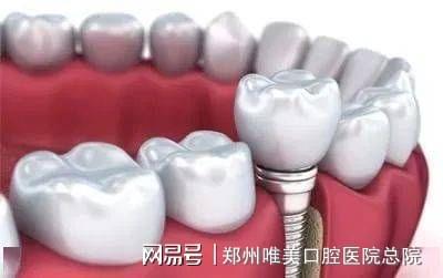 郑州60岁老人种牙好吗？详解高龄种植牙的利弊与郑州选择