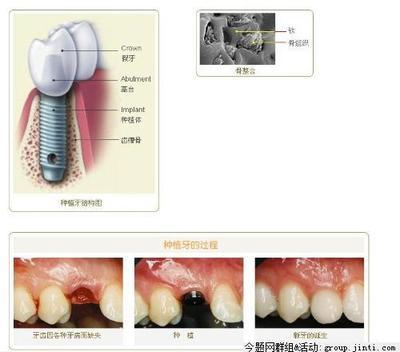 郑州种植牙多少钱一颗？河南种植牙价格解析与选择指南