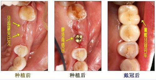 郑州种植牙攻略 如何选择靠谱医院与优秀医生？