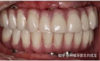 郑州无牙颌种植方案解析 全口/半口种植牙与医师选择的关键指南