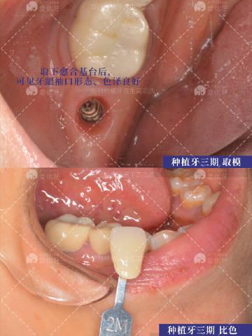 郑州种植牙 以右下7号牙缺失为例，解析种植牙三步曲