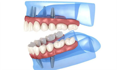 2025郑州种植牙费用全解析 最新价目表、避坑指南与省钱攻略