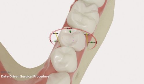 种牙好还是镶牙好？不妨来了解下韩国DIO种植体与郑州种植牙